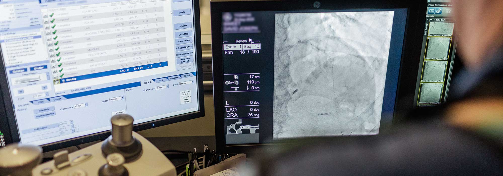 Angioplasty computer screens and controller